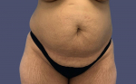 Abdominoplasty (Tummy Tuck) 23 Before